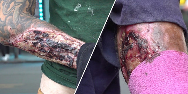 Drug users with flesh-eating tranq wounds