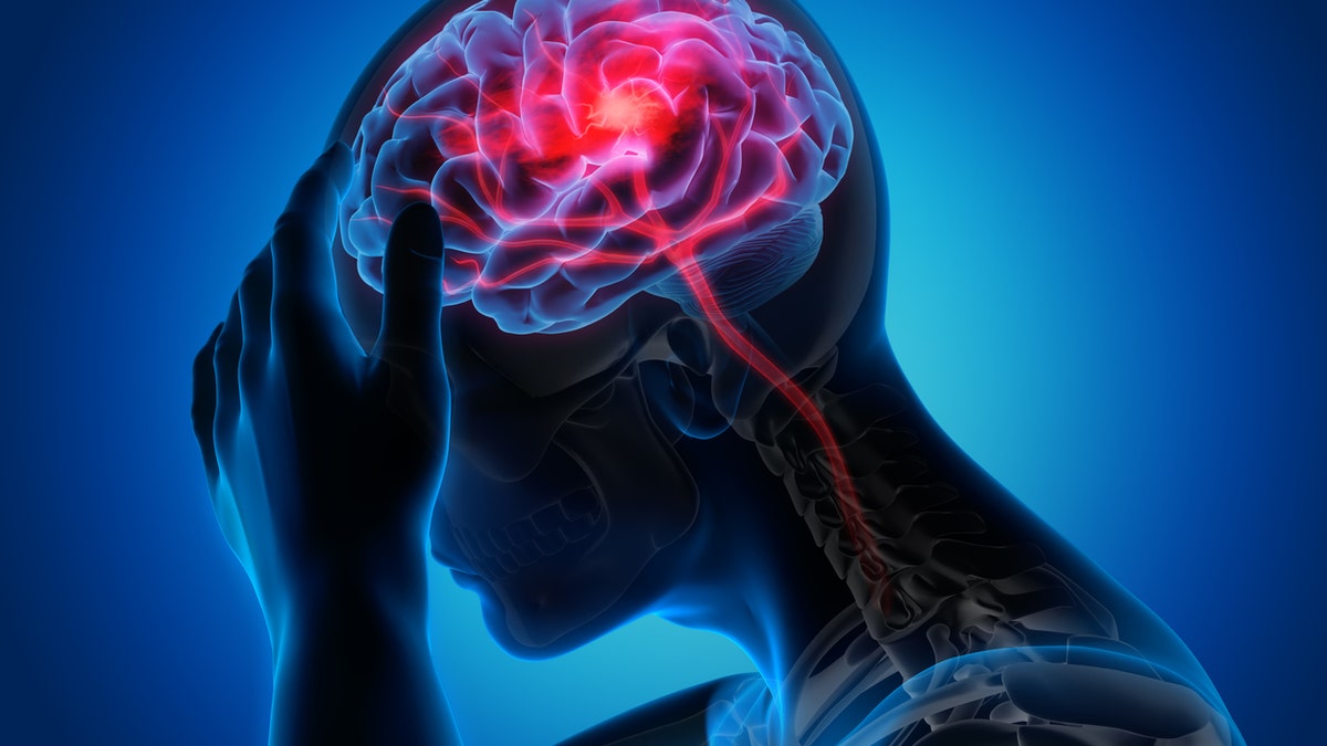 Medical illustration of a brain with stroke symptoms