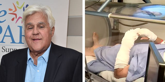 After comedian and classic car collector Jay Leno suffered from "serious burns" in a gasoline fire while working on one of his vehicles, the 72-year-old underwent treatment. 