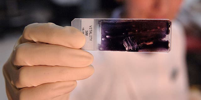 A laboratory holds up a slide with sperm on it at the Sydney IVF Clinic in Sydney, Australia, Thursday, October 12, 2006. 