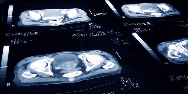 FILE - X-Ray Slides of a Patient with Prostate Cancer
