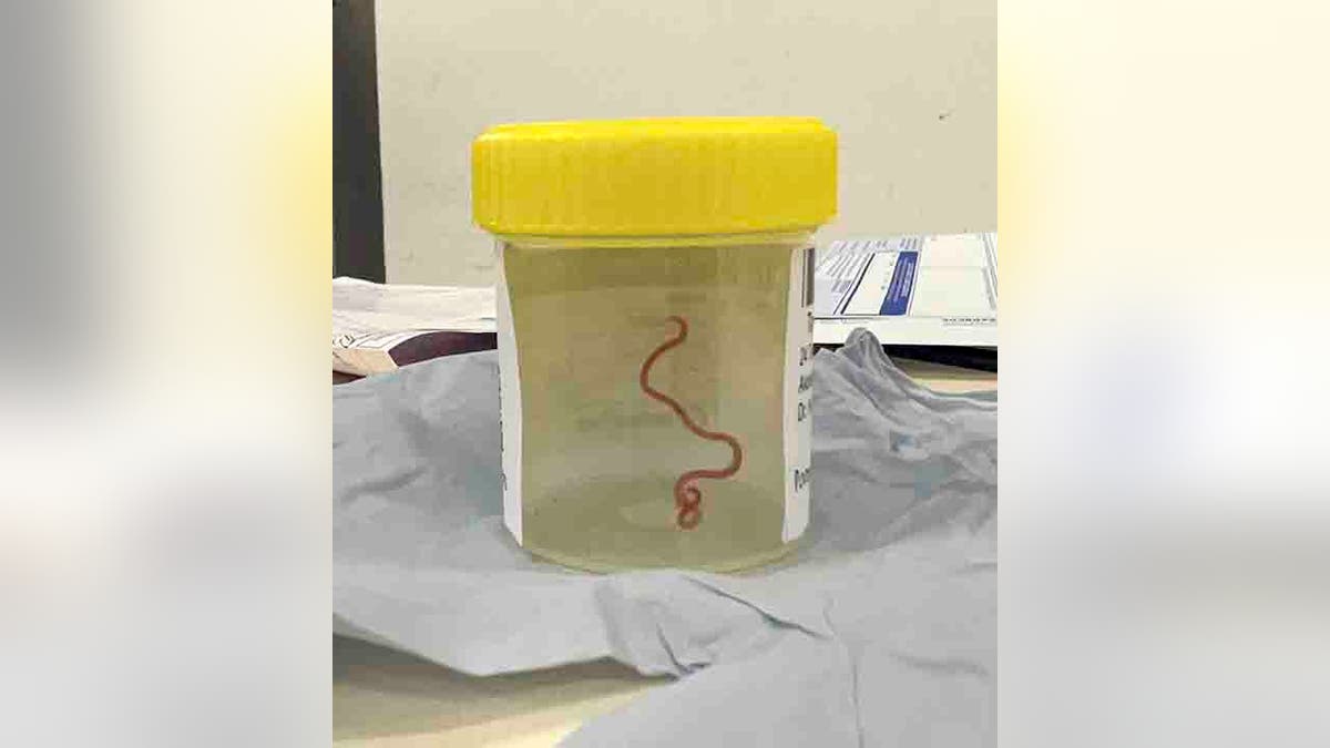 parasite in a specimen jar