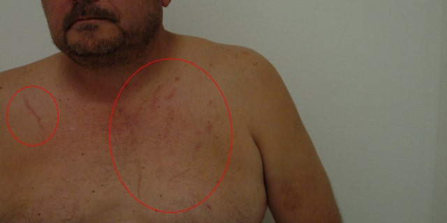 A shirtless Mario Garcia with scratchmarks on his chest