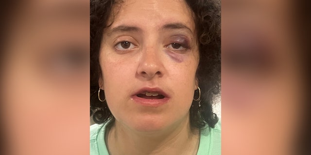 Rockville, Maryland victim with black eye