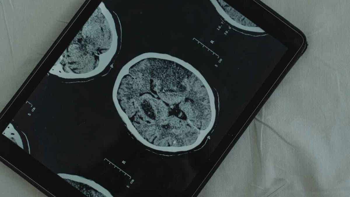 An image of a scanned brain on a tablet.
